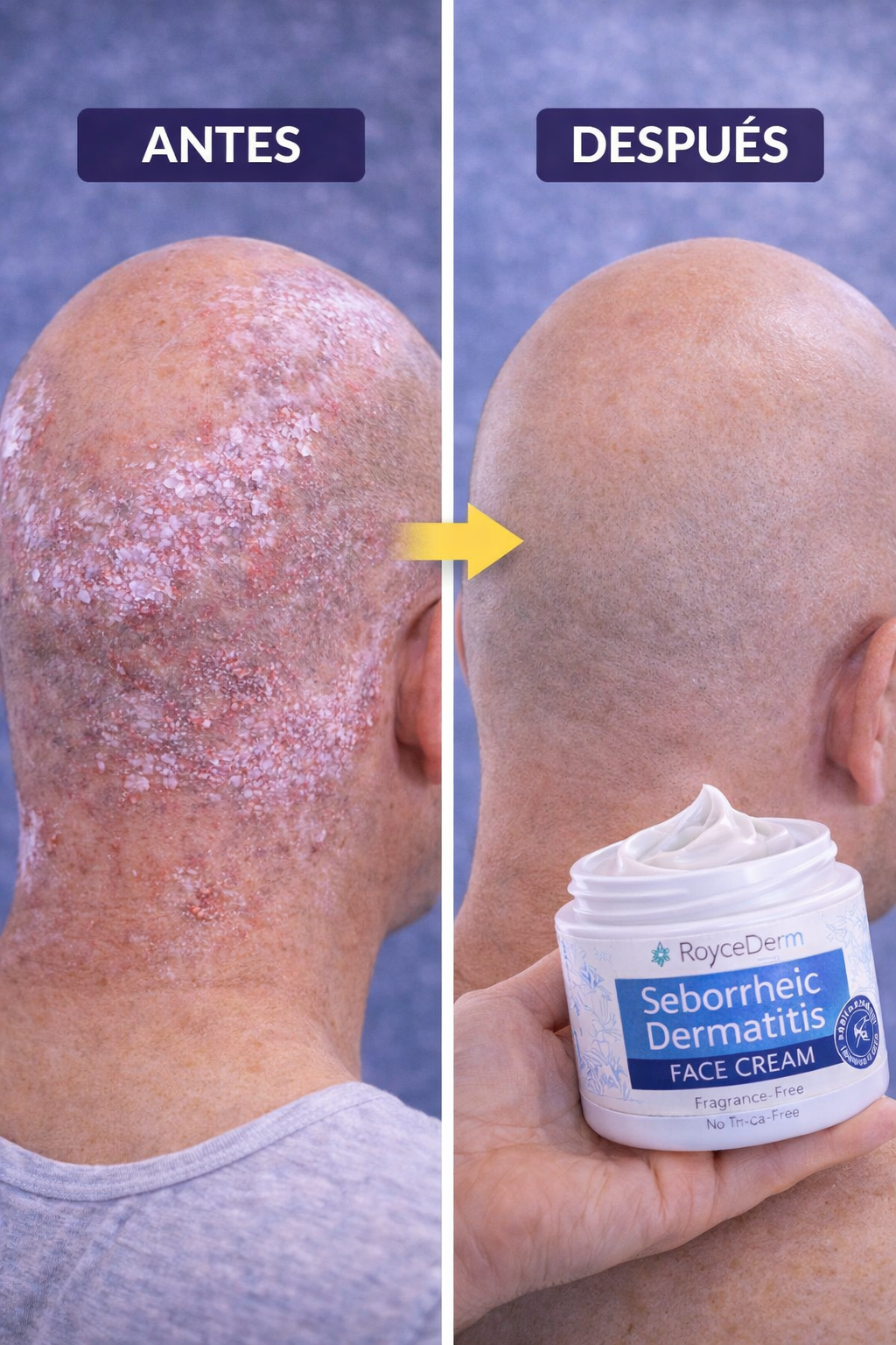 Roycederm Seborrheic Dermatitis BioCalm Skin Repair