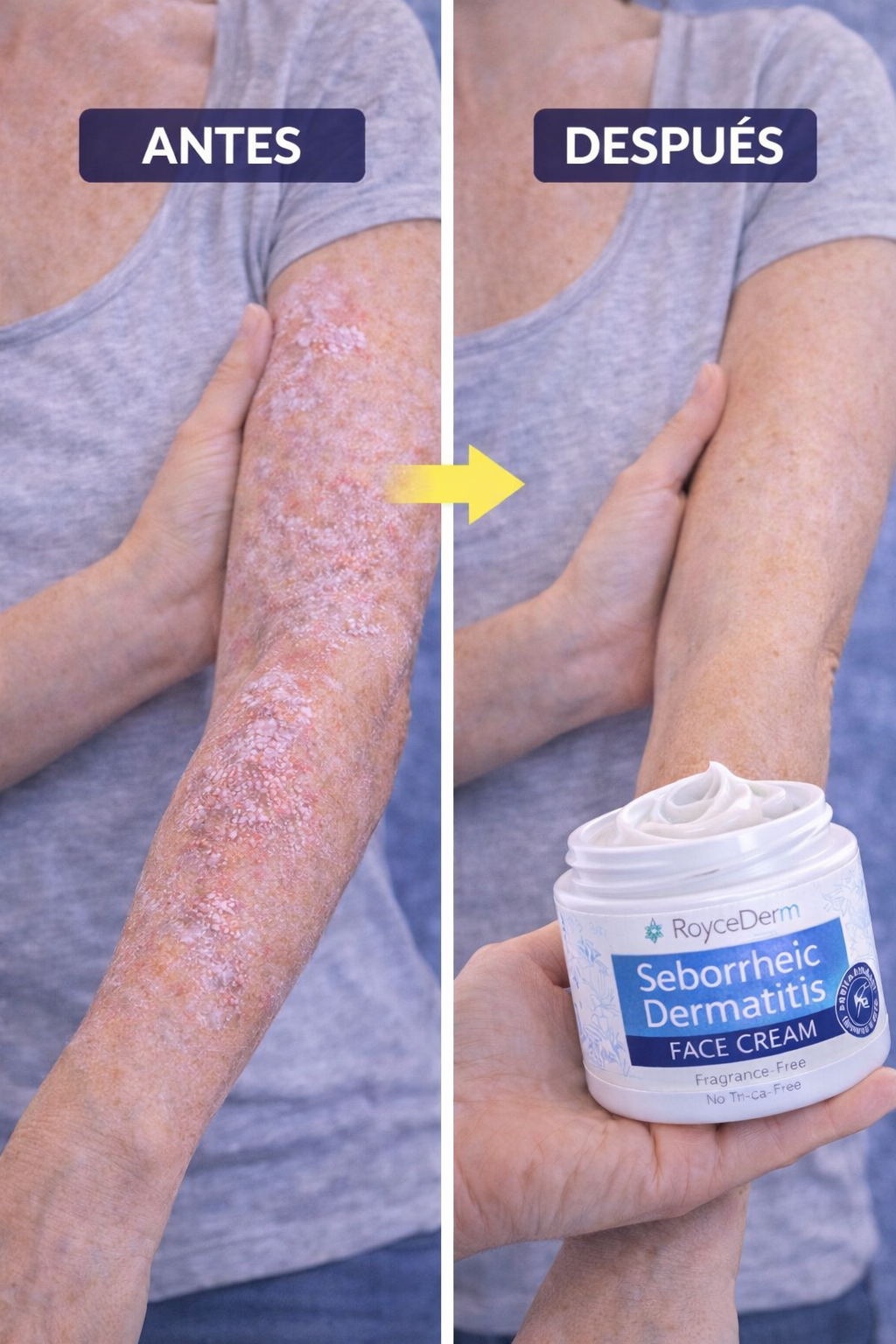 Roycederm Seborrheic Dermatitis BioCalm Skin Repair